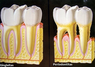 Periodontologinis gydymas